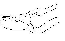 First Metatarsal Phalangeal Joint Arthrodesis