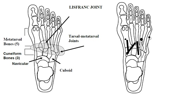 Lisfranc Injury Treatment Minnesota