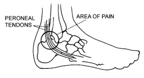 Peroneal Tendon Surgery