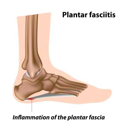 plantar fasciitis doctor edina