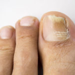 runner's toenail