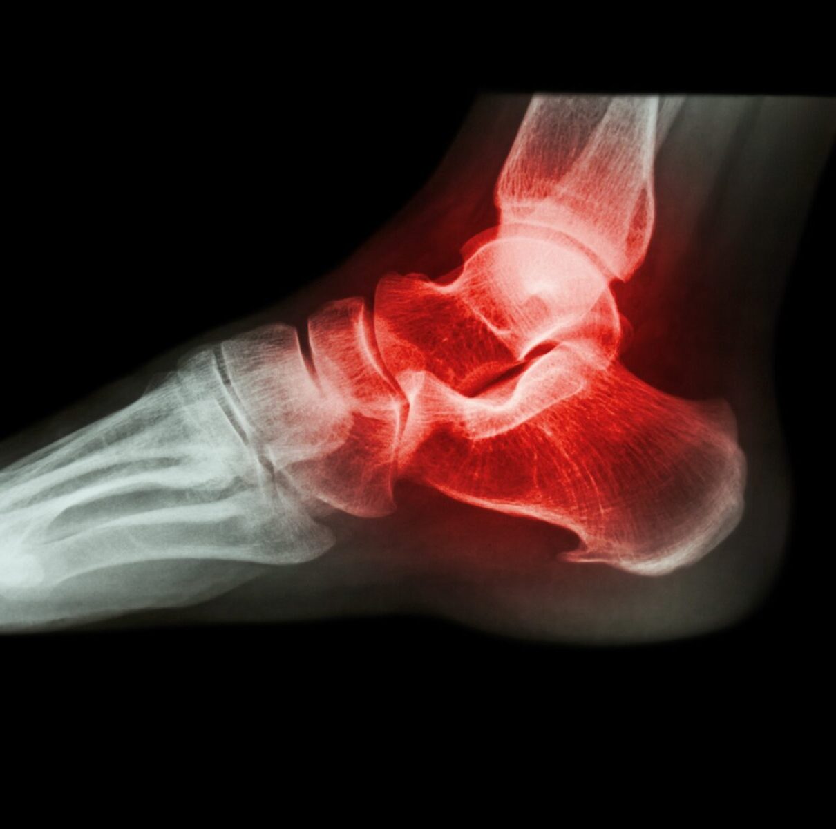 ankle arthritis Silverman Ankle & Foot Edina Orthopedic Surgeon