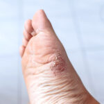 palmoplantar psoriasis