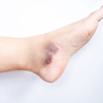 foot bruising